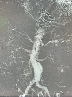 Bufalini_CO2_Type Ib EL after bEVAR _18Fr33cm sheath_100cc750mmHg Bufalini_CO2_Type Ib EL after bEVAR _18Fr33cm sheath_100cc750mmHg