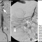 EMORRAGIA-GASTROINTESTINALE-ACUTA-300x172-EVAR-150x150