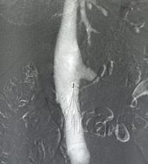 IVC filter