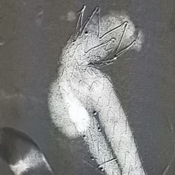 Klinikum Chemnitz (GER)_Type I Endoleak_dr. Seifert