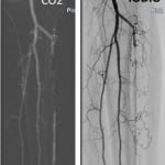 tibial-artery-150x150