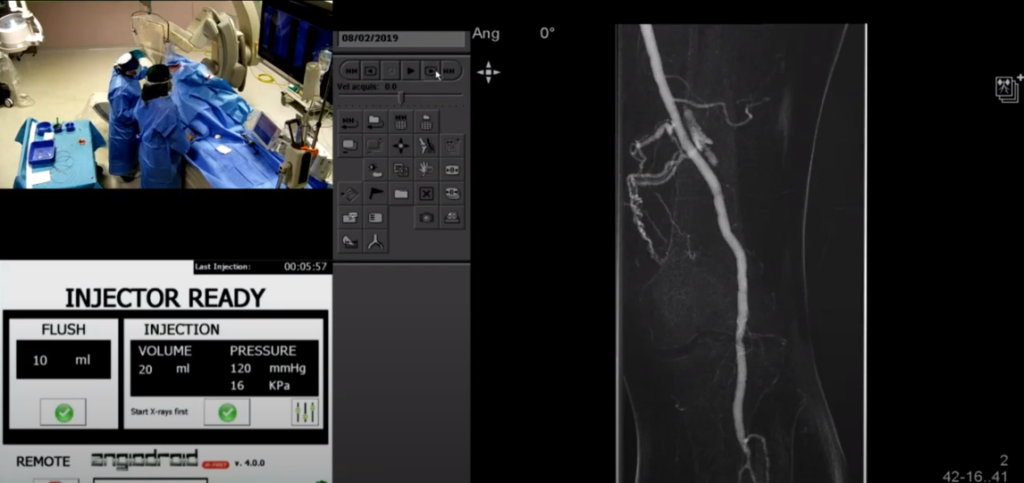 CO2 automatic angiography – Standard Technique