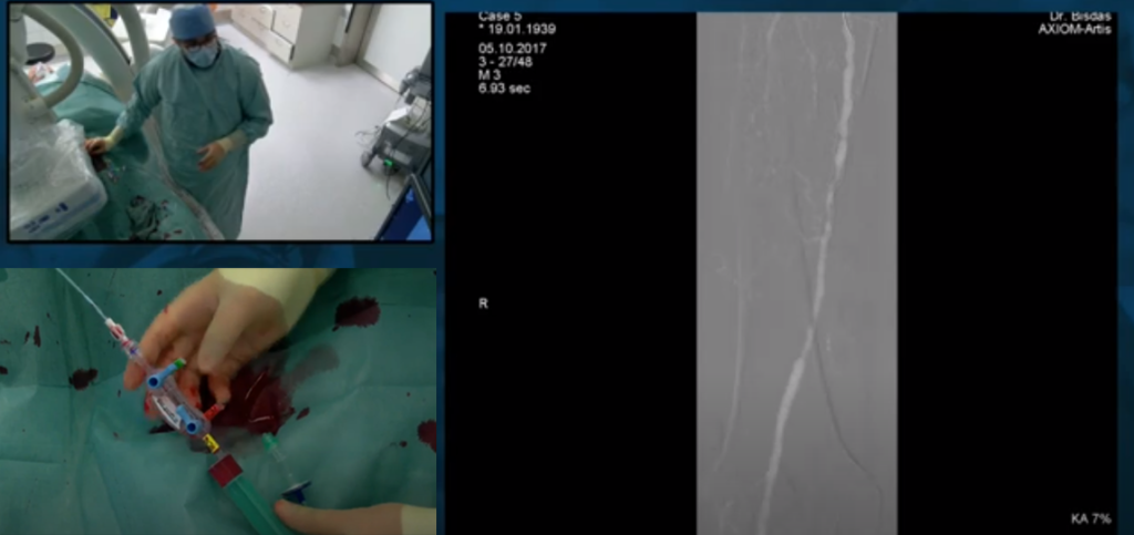 Automated CO2 Angiography and PTA Live Demo