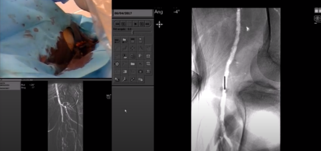 Automated CO2 Angiography and Critical Limb Ischemia