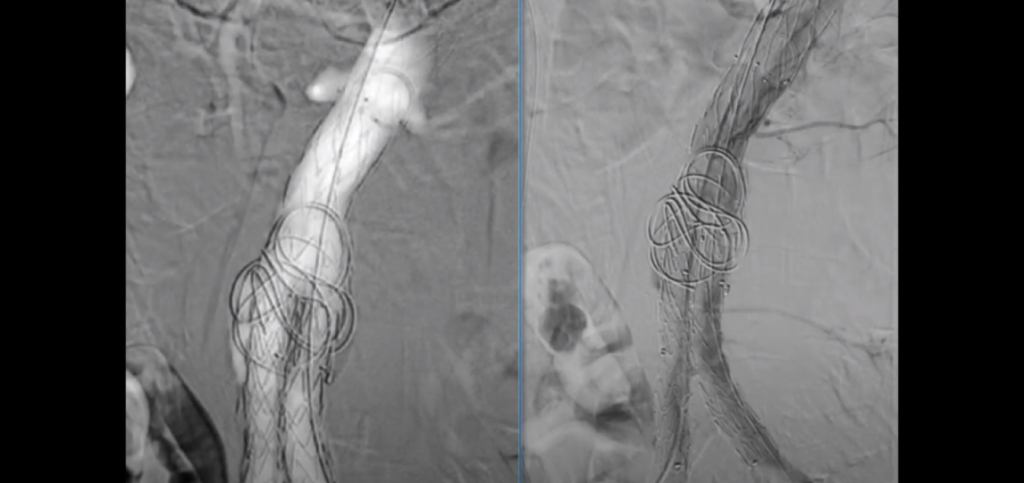 Automated CO2 Angiography and EVAR