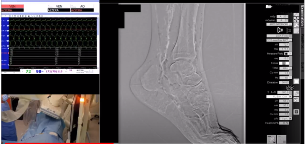 Automatic CO2 Angiography Presentation Dr. Ferraresi