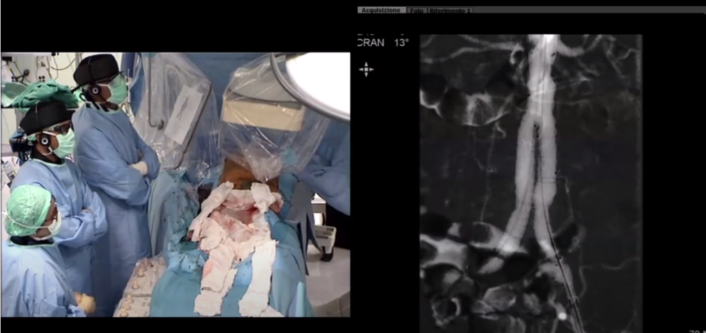 Zero Contrast EVAR – Endovascular Aneurism Repair with CO2 angiography