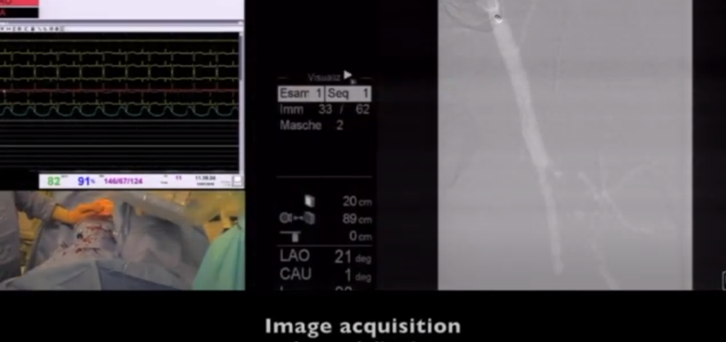 Automated CO2 Angiography - Live Demo